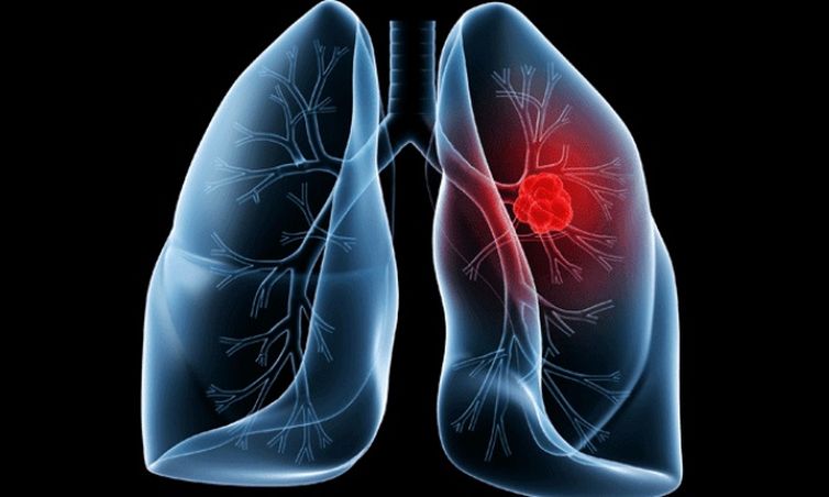 Adenocarcinoma Pulmonar: Entenda o Câncer que Afetou o Papa Leão