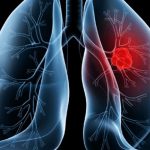 Adenocarcinoma Pulmonar: Entenda o Câncer que Afetou o Papa Leão