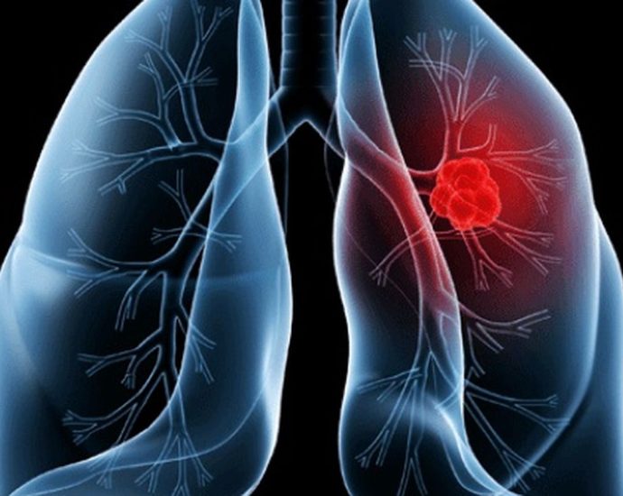 Adenocarcinoma Pulmonar: Entenda o Câncer que Afetou o Papa Leão