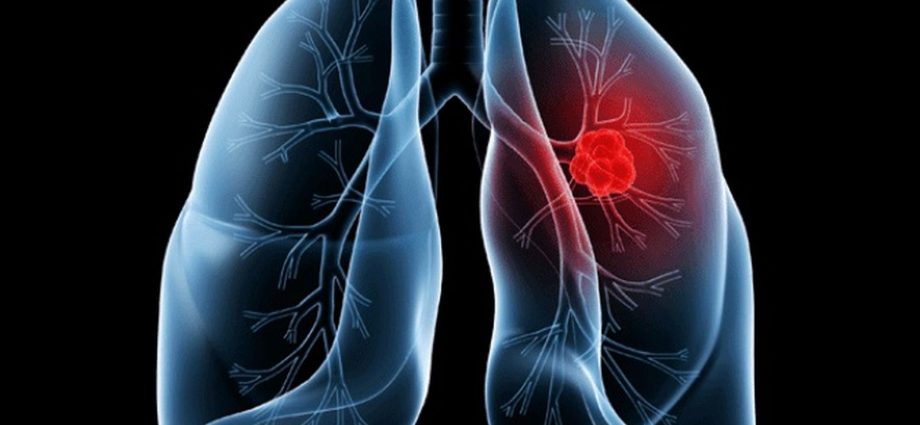 Adenocarcinoma Pulmonar: Entenda o Câncer que Afetou o Papa Leão